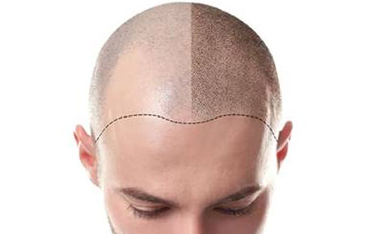 Saç Ekimi Tedavisi ve Saç Dizayn & Kalıcı Makyaj