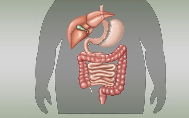 Laparoskopisk ærme Gastrektomi / gastrisk ærme