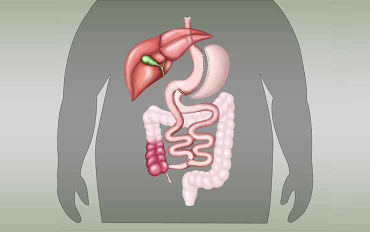 Metabolik Cerrahi Tip 2 Diyabet (Şeker) Ameliyatı