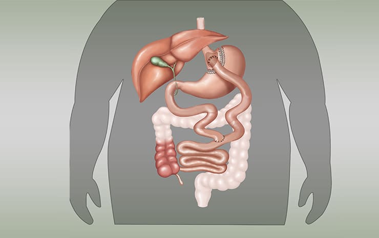 Laparoscopic Gastric By-Pass Surgery